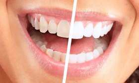 Blanqueamiento Dental en 2 Sesiones + Profilaxis, Limpieza y Consulta Odontológica