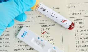 Análisis PSA: examen de antígeno prostático específico