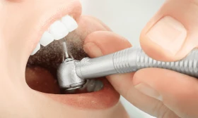 Limpieza Dental Profunda | Elimina Sarro y Mejora tu Salud Bucal